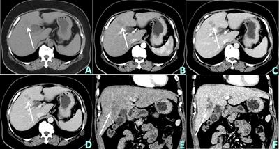 A hepatic sparganosis misdiagnosed as intrahepatic mass-forming cholangiocarcinoma: a case report and literature review